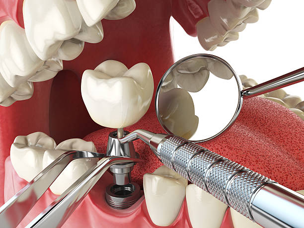 Best Emergency Wisdom Teeth Removal in Johnsonburg, PA